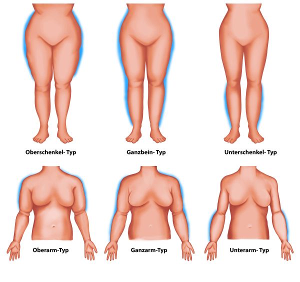 Typen_Lipoedem